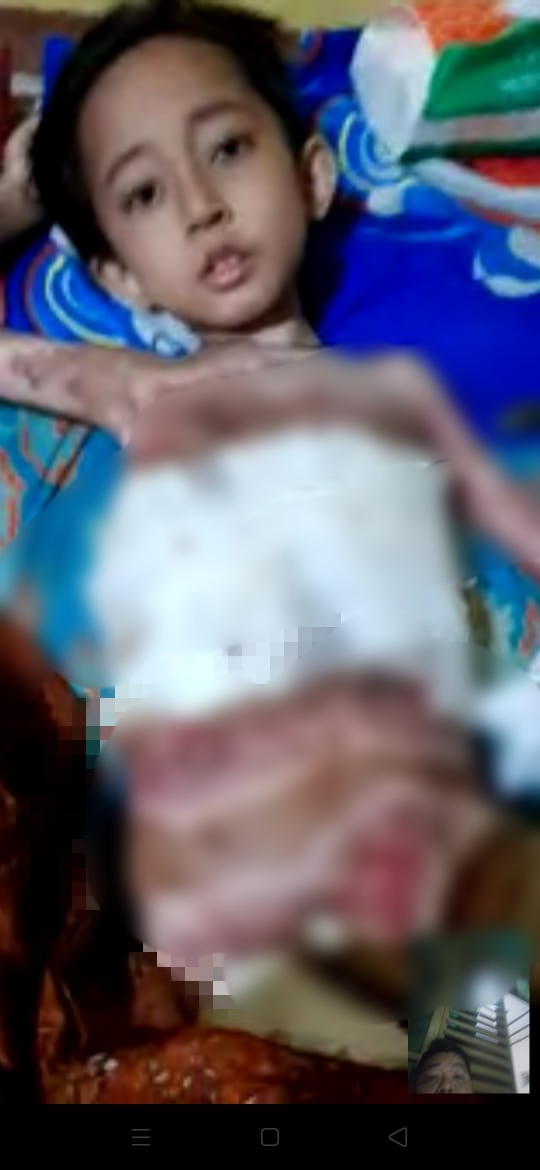 Bocah Desa Banjarsari Korban luka Bakar Butuh Perhatian Pemkab